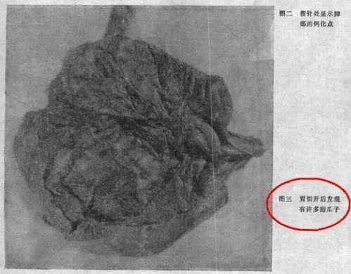 辛追吃瓜死亡,一场悲剧引发的食品安全警钟-第2张图片-网曝911黑料热点事件 辛追吃瓜死亡,一场悲剧引发的食品安全警钟-第2张图片-网曝911黑料热点事件